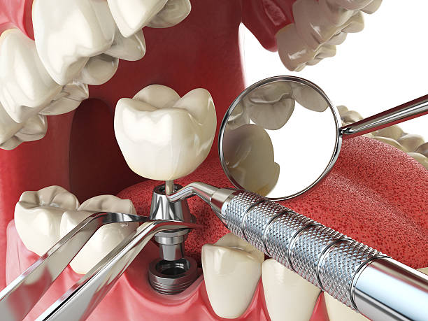 Best Emergency Root Canal Treatment in Ronceverte, WV